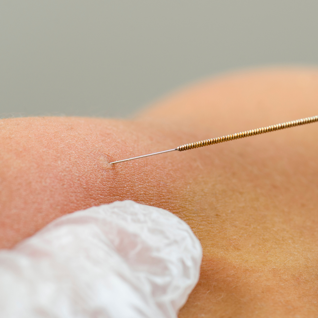 Precise dry needling therapy applied for effective pain relief and improved mobility by the best dry needling physiotherapy in JP Nagar.